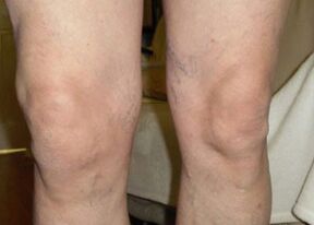 Pred použitím Osteflexu boli Nilsove kolená na konci dňa opuchnuté.